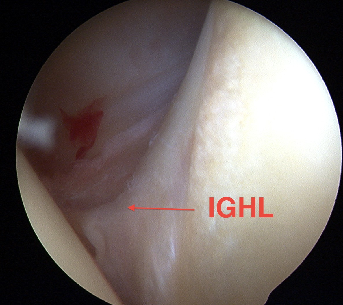 Normal IGHL Glenoid Attachment